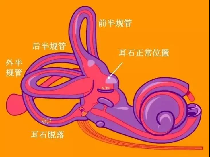 耳石症